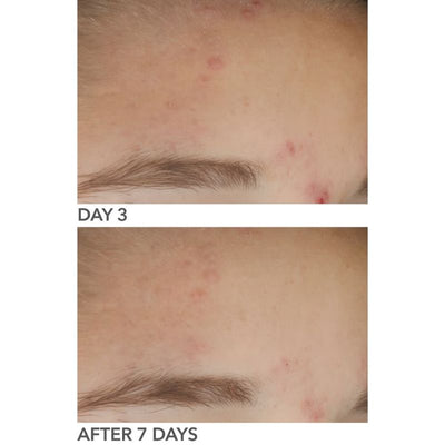Dr Dennis Gross Alpha Beta On The Spot Gel 30ml