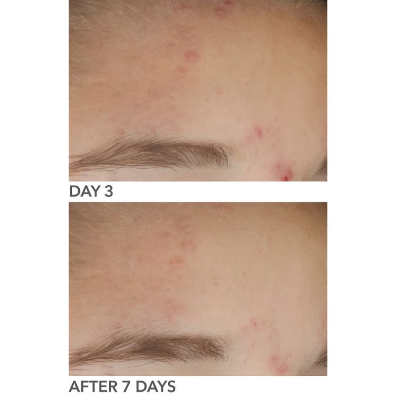 Dr Dennis Gross Alpha Beta On The Spot Gel 30ml